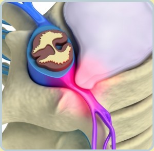 Межпозвонковая грыжа