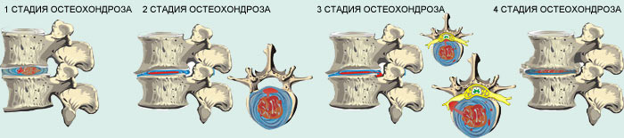 Стадии остеохондроза