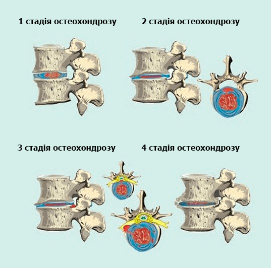 стадія остеохондрозу